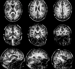 Improved MRI scans of the myelin sheaths in the brain should allow multiple sclerosis to be detected at an early stage.