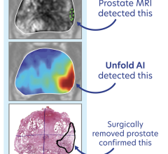 For the first time in a commercial setting, physicians are able to see the extent of disease and provide more personalized and precise treatments for prostate cancer patients using AI