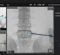 Siemens Healthineers Releases Software for Trackerless Guidance in Spinal Surgery