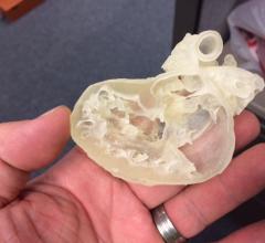 Nemours Children's Health System Uses 3-D Printing to Deliver Personalized Care