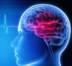 Rapid Response Teams Expedite Stroke Imaging, Treatment