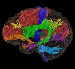 Synaptive Medical Launches Modus Plan With Automated Tractography Segmentation