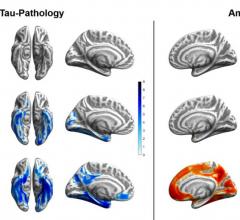 Tau (blue) and amyloid (orange) distribution patterns for super-agers, normal-agers and MCI patients, when compared to a group of younger, healthy, cognitively normal, amyloid-negative individuals. Brain projections are depicted at an uncorrected significance level of p < .0001. Color bars represent the respective t-statistic. Image courtesy of Merle C. Hoenig, Institute for Neuroscience and Medicine II - Molecular Organization of the Brain, Research Center Juelich, Juelich, Germany, and Department of Nucle