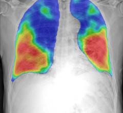 COVID-19 pneumonia color coded in red and yellow by an automated artificial intelligence (AI) analyses tool to prescreen chest X-ray images from the new Thirona and Delft Imaging CAD4COVID detection software. It is intended to support healthcare manage COVID-19 cases. The tool will help triage COVID-19 cases and indicate the affected lung tissue. The software is being made available free-of-charge in support of the crisis.