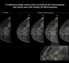 An example of breast tomosynthesis 3-D mammography detection of lesion.