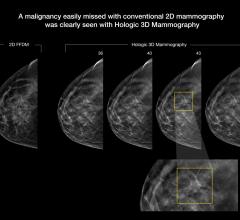 VuComp, M-Vu CAD, structured reporting, SR, digital breast tomosynthesis