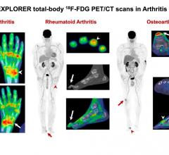 Left: Total-body PET/CT in psoriatic arthritis: multiple joints affected, shoulders, elbows, wrists, knees, ankles and small joints of the hands/feet. Arrow: left wrist; arrowhead: right wrist. Middle: Total-body PET/CT in rheumatoid arthritis: multiple joints affected, right shoulder, small joints of the left hand. Arrowhead at the 4th proximal interphalangeal joint shows classic ring-like uptake pattern. Arrow on the foot images demonstrates the hammer toe deformity besides big toe arthritis. Right: Total