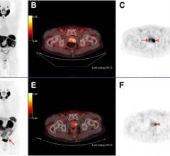 Maximum-intensity projections, transaxial fusion, and PET images of 18F-PSMA1007 (A-C) and 68Ga-PSMA-11 (D-F) PET/CT scans of 67-y-old patient with GS 8 and PSA 4.9 ng/mL. Marked uptake is seen in urinary bladder and left ureter (arrow) on maximum-intensity projection image of 68Ga-PSMA-11 (D), as opposed to nearly negligible 18F-PSMA-1007 urinary excretion (A). Dominant lesion in left prostatic lobe is evident on both scans (arrowheads). However, second lesion is seen in right lobe only on 18F-PSMA-1007 sc