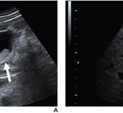 Transverse (A) and sagittal (B) greyscale ultrasound images of gallbladder show 25-mm nonmobile sessile polyp with adjacent wall thickening (arrow, A; calipers, B). Polyp was classified as extremely low risk by no readers, low risk by 4 readers, and indeterminate risk by 6 readers. Surgical consultation was recommended by all 10 readers. Pathologic assessment from cholecystectomy yielded adenoma, consistent with benign neoplastic polyp.