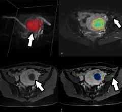 Uterine Fibroid Embolization Safer and as Effective as Surgical Treatment