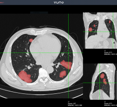 #COVID19 #Coronavirus #2019nCoV #Wuhanvirus #SARScov2 the company is now offering a suite of AI solutions Vuno Med-LungQuant and Vuno Med-Chest X-ray for COVID-19, encompassing both lung X-ray and computed tomography (CT) modalities respectively all at once