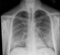 This chest X-ray of a patient being treated for e-cigarette or vaping-associated lung injury shows lung opacities, densities and whitish cloud-like areas which are typically seen with unusual pneumonias, fluid in lungs or lung inflammation. Image courtesy of Intermountain Healthcare