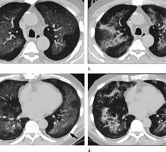 Electronic cigarette or vaping product use-associated lung injury in a 51-year-old man manifesting as an acute lung injury pattern at CT with subsequent organization. 