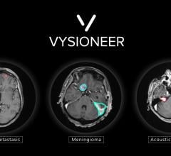 Brain tumors edged out by artificial intelligence: VBrain applies auto-contouring to the three most common types of brain tumors: brain metastasis, meningioma and acoustic neuroma.