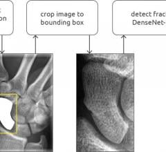 Overview of the scaphoid fracture detection pipeline, which consisted of a segmentation and detection convolutional neural network (CNN). A class activation map is calculated and visualized as a heatmap for fracture localization. Image courtesy of Radiological Society of North America