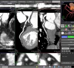 coronary CT angiography, CCTA, CAD, coronary artery disease, alcohol consumption, RSNA 2016