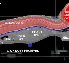Pediatric Brain Tumor Patient From the U.K. Undergoes First Treatment of Proton Therapy