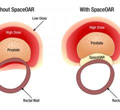 SpaceOAR System, prostate cancer radiotherapy, rectum spacer, first in Florida 