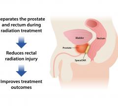 Augmenix, SpaceOAR System U.S. Clinical Trial, results, Urology Practice, prostate cancer, radiotherapy