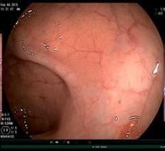 Avantis Medical Systems, Third Eye Panoramic colonoscopy device, endoscopes, FDA, resposable