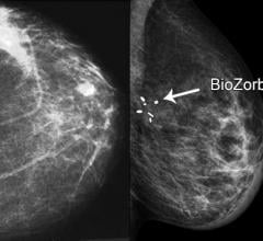 Research Shows Breast Cancer Surgery Marker Associated With Smaller Radiation Volume