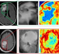 Case Western Reserve University study, machine learning, MRI, brain cancer diagnoses, radiomics