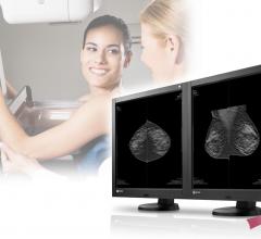 Solis Mammography, Texas, HB 1036, insurance coverage, 3-D mammography, tomosynthesis