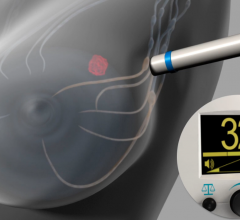 The Magtrace and Sentimag Magnetic Localization System uses magnetic detection during sentinel lymph node biopsy procedures to identify specific lymph nodes, known as sentinel lymph nodes, for surgical removal. The FDA granted approval of the Sentimag System to Endomagnetics Inc.