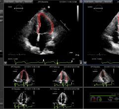 Strain Imaging Improves Cardiac Surveillance of Certain Breast Cancer Patients