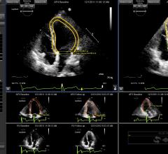 Epsilon Imaging, EchoInsight, left ventricle, LV measurement, strain imaging, ASE 2016