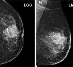 BioZorb three-dimensional implant, breast cancer, radiation therapy targeting, World Journal of Surgery article, ASTRO 2016 study