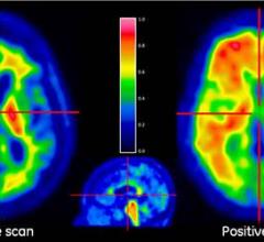 Alzheimer's, tau PET tracers, positron emission tomography, dementia, research