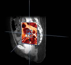 MIM Software Highlights Deformable Breakthrough for HDR 