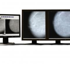 Parascript, AccuDetect 7.0, FDA approval, computed-aided detection for mammography
