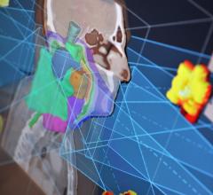 RaySearch Launches Latest Version of Treatment Planning System