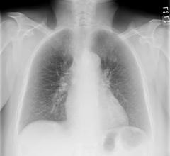 RiverainClearRead Bone Suppression ClearRead + Detect X-Ray 