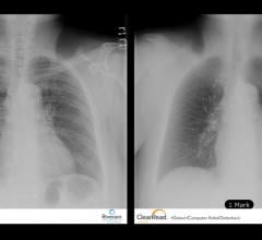 ClearRead Software Improve X-ray Images