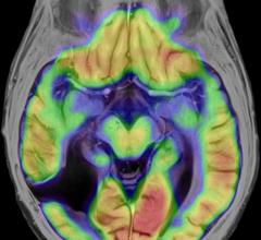 PET, neuroinflammation, C-11 PBR28, dementia, SNMMI 2015