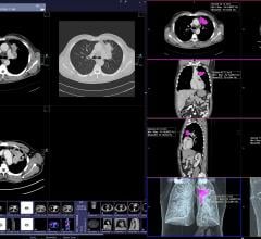 Siemens, low-dose lung cancer CT screening, Somatom, RSNA 2015