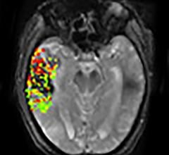 DEFUSE-2 studym, MRI, brain bleeding risk, post-stroke treatment, NIH