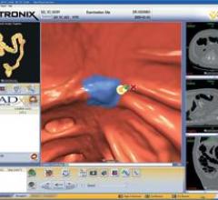 iCAD, USPSTF, colorectal cancer screening recommendations, VeraLook computer-aided detection software