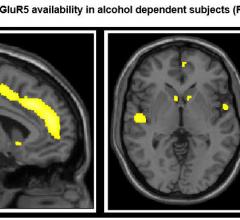 PET-CT study, alcoholic brain, SNMMI 2016, mGluR5 receptor
