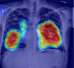 RADLogics AI-Powered solution in use: chest X-ray of COVID-19 positive case with heatmap key image.