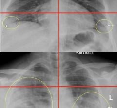 Chest radiograph of a 23-year-old male with no past medical history who tested positive for COVID-19 via RT-PCR and was subsequently discharged from the emergency department with home care and isolation precautions. Portable CXR shows right and left peripheral lower lung zone hazy opacities; total score=2