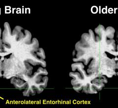 The yellow in the anterolateral entorhinal cortex of the young brain indicates significant activity, something that is absent in the older brain.