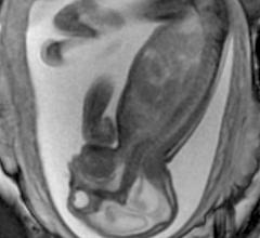 Prenatal MRI of a Zika fetus showing enlarged cerebral fluid space, dilation of the cerebral ventricles, thinning of brain tissue, poorly developed cerebellum and the absence of brain cortical gyri. (Image coutesy of RSNA)