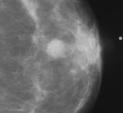 Figure 8. Abnormal mammogram.