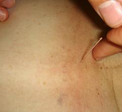 After receiving acupuncture treatment three days a week during the course of radiation treatment, head and neck cancer patients experienced less dry mouth, according to study results from researchers at The University of Texas MD Anderson Cancer Center