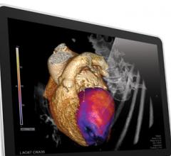 Vital Images VitreaExtend Advanced Visualization Toshiba America Medical Systems