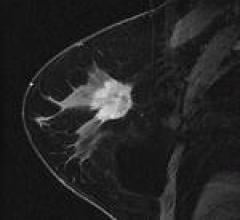 MRI with Ultrasound Identifies Breast Cancer Before Metastasis